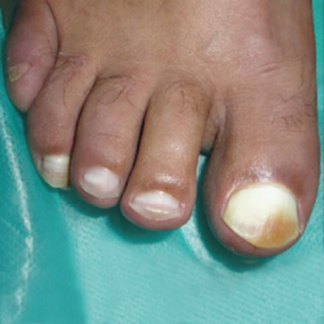 toenails turning white