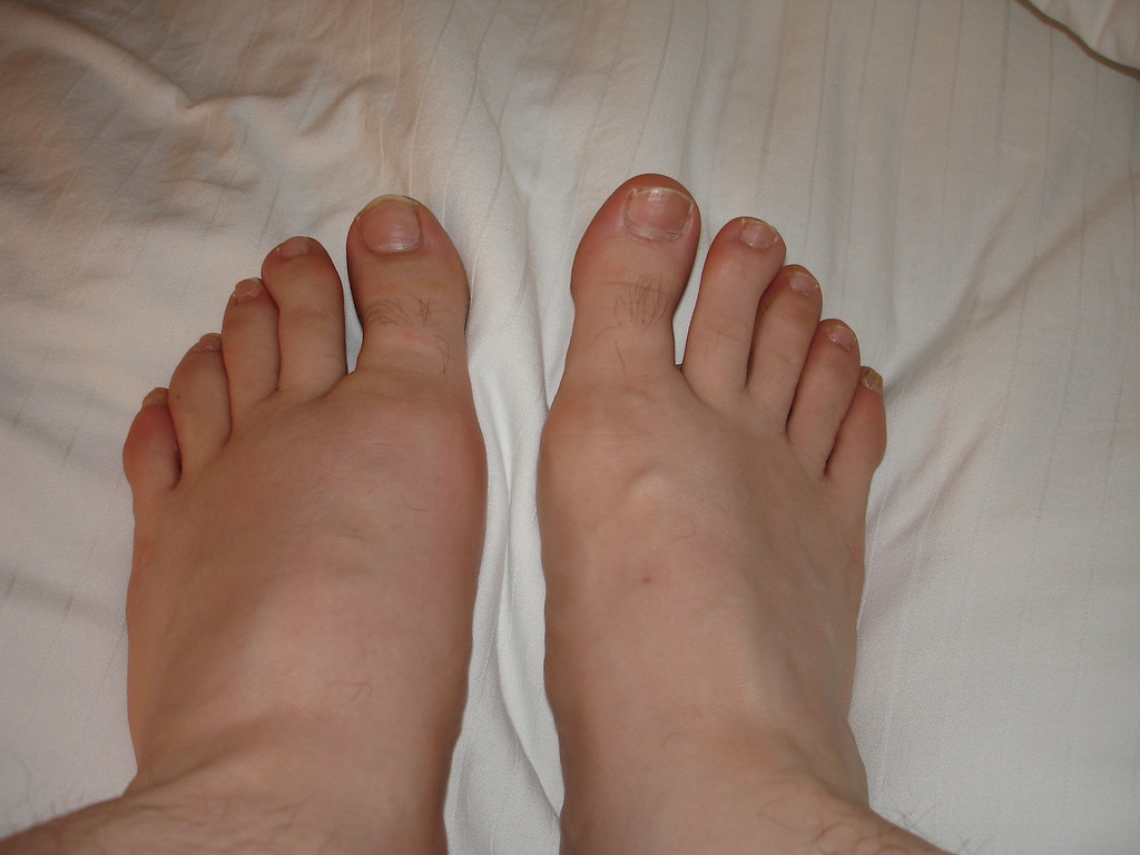 Gout swollen left foot