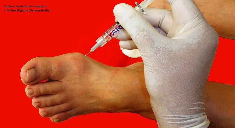 Sodium Hyaluronate in Hallux Rigidus