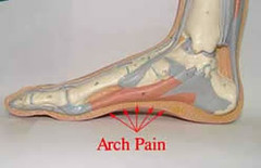 Plantar Fasciitis