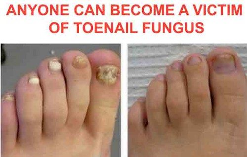 Anyone can become a victim of toenail fungus